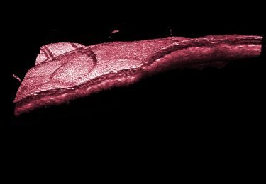 Optical Coherence Tomography, OCT