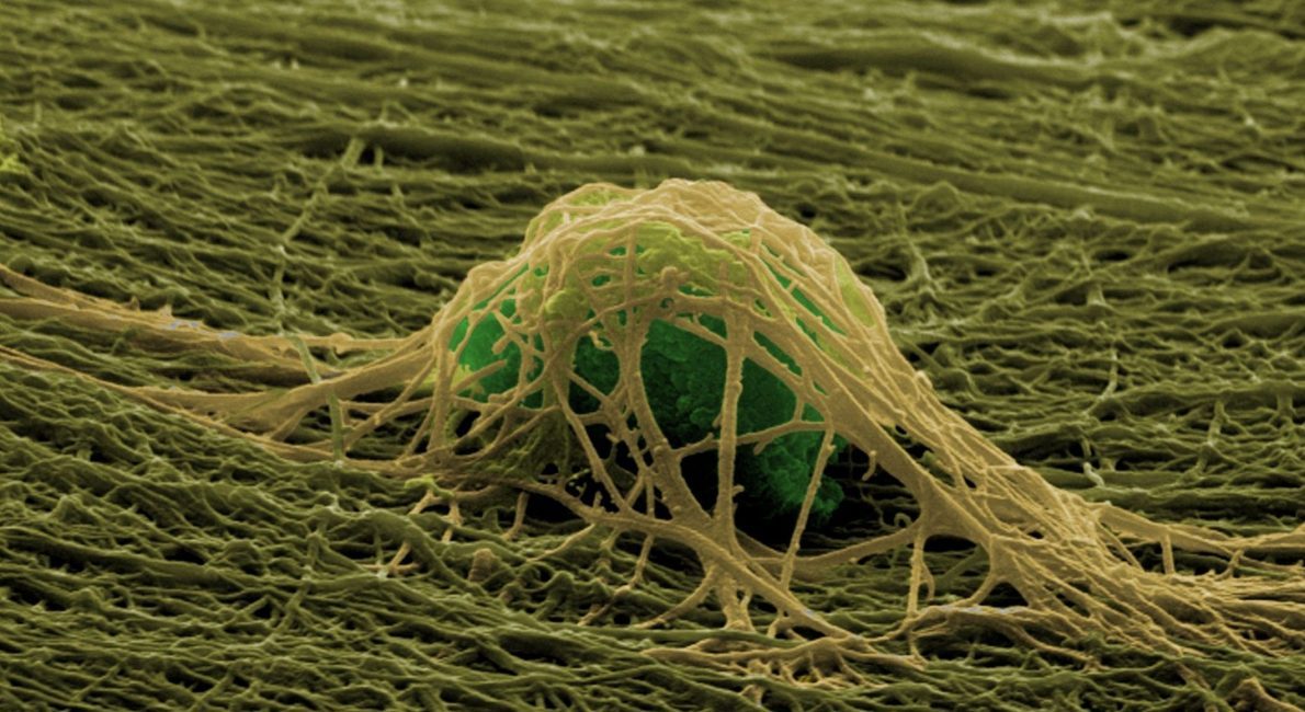 Electrospinning bone implants