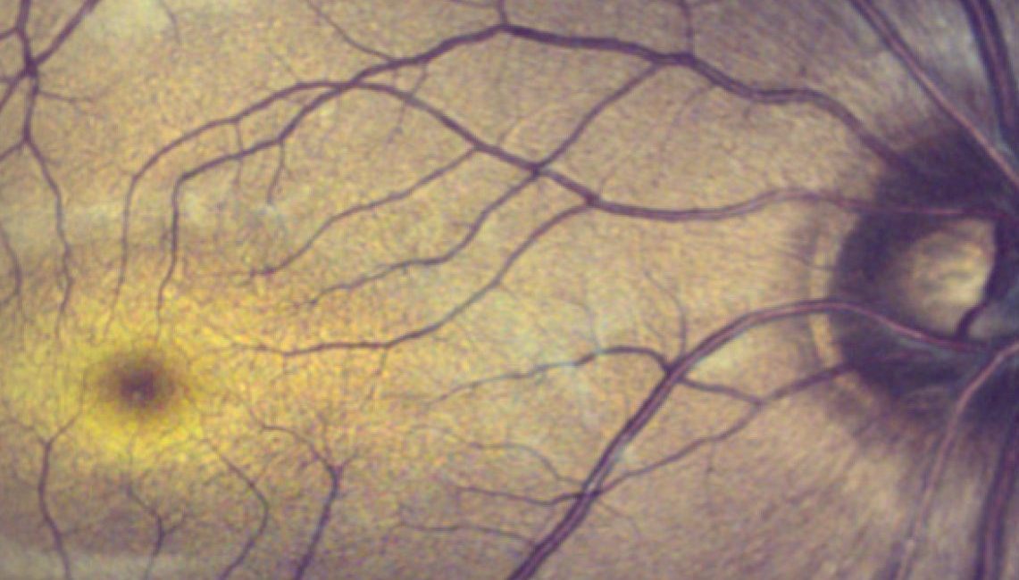 True color retinal imaging using broadband supercontinuum laser in handheld OCT/SLO probe