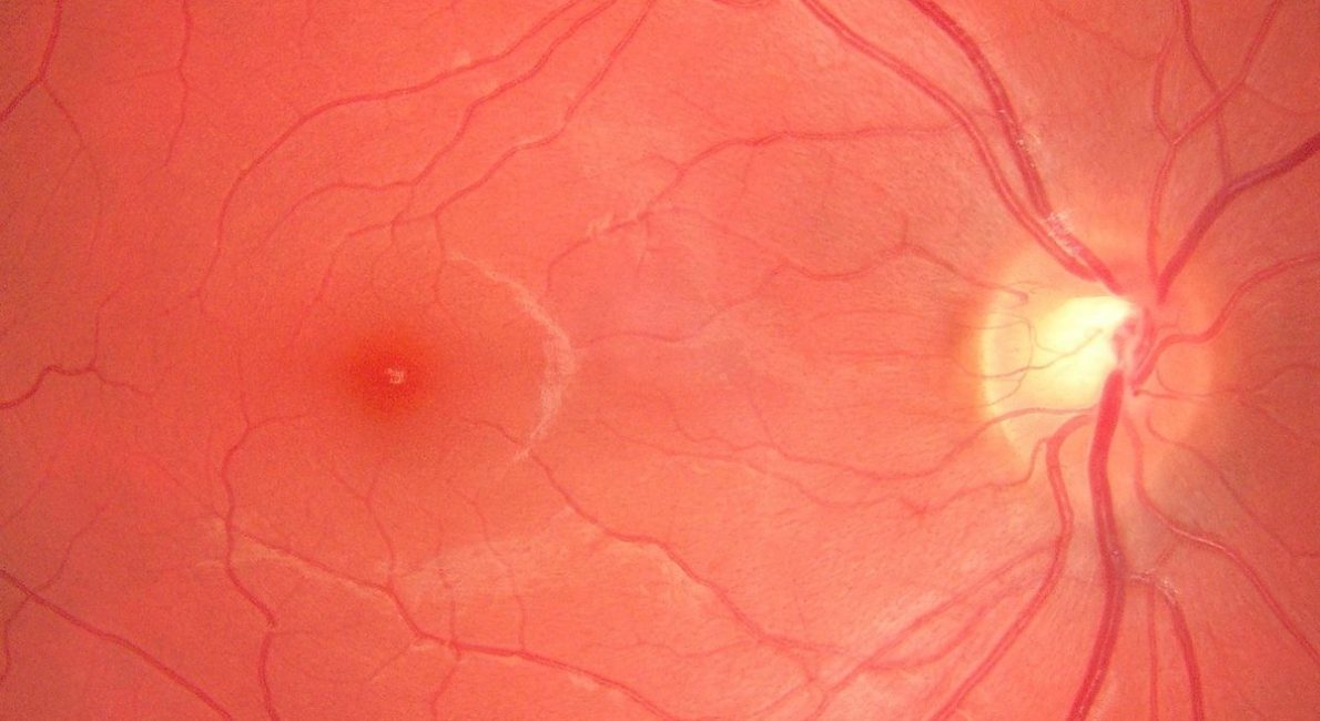 Ophthalmic OCT retina imaging enabled by SuperK supercontinuum white light lasers delivering broadband visible‑to‑nIR illumination for sub‑micron resolution